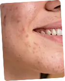 Acne & Acne Scars