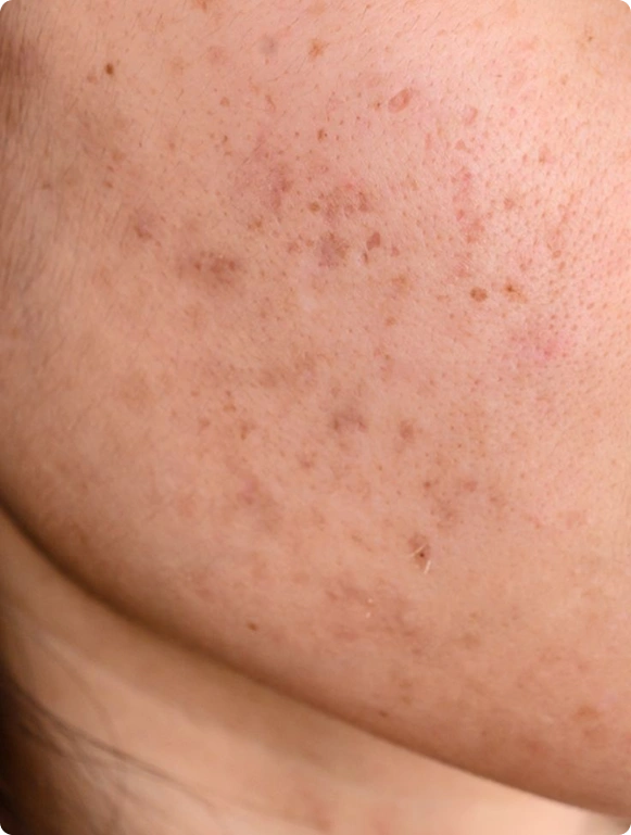 The smarter way to even skin tone